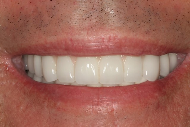 Dental Restoration Smile