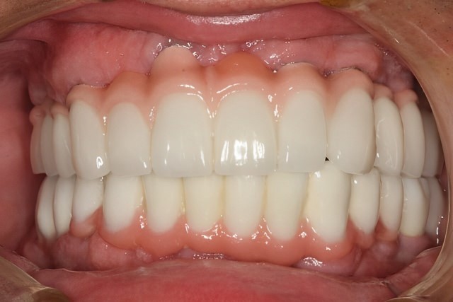 Dental Restoration Teeth