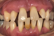 advanced gum loss closeup1 (1)