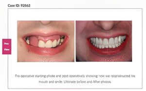 patient’s smile before and after bar overdenture implants, missing tooth and smile restored after treatment