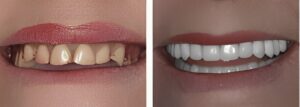 dentures winterba