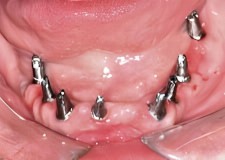 erosion mandibular implants 1