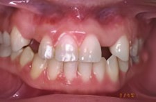 genetic missing teeth 2 (1)