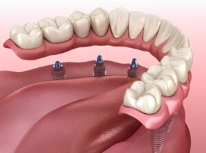 3D illustration of lower implant dentures being placed onto gum on small metal pegs