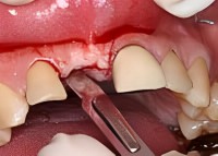 incisor socket graft