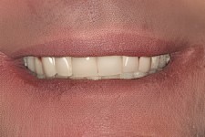 jw gum disease temporary teeth