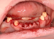 jw diseased mandible extractions (1)