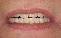 Hampton Dental Associates dentures 2