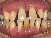 periodontitis bone loss