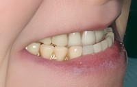picture of person smiling with prosthodontic bite