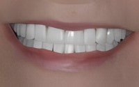 prosthodontic bitepicture of perfect smile after procedure
