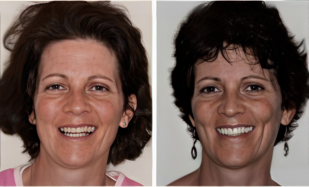 smiling female patient before and after reconstructive dentistry