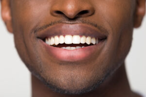 Close,Up,View,Of,Beaming,Orthodontic,White,Wide,Male,Smile,