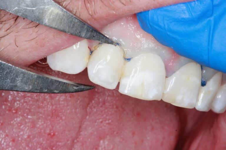 Before Image: Advanced Composite Bonding - front