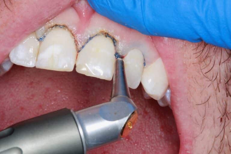 After Image: Advanced Composite Bonding - front