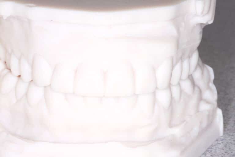 Before Image: Advanced Composite Bonding - front