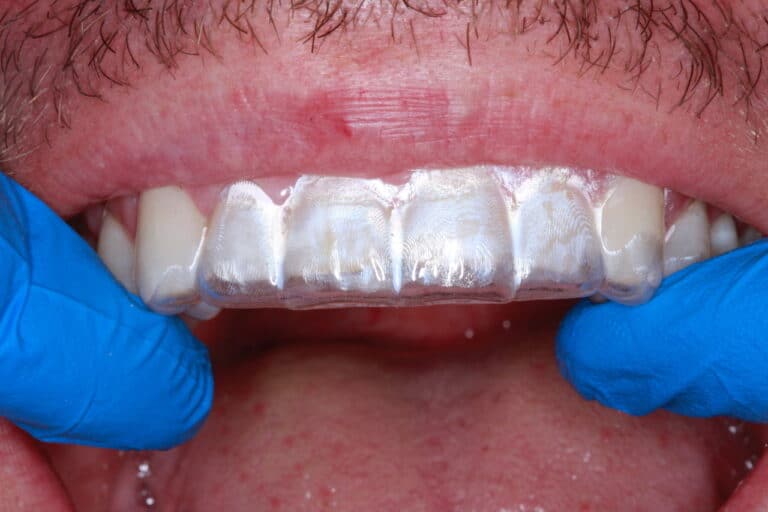 After Image: Advanced Composite Bonding - front
