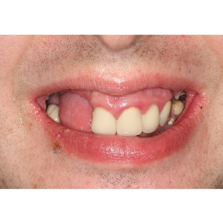 Before Image: Sinus Lift Patient - front