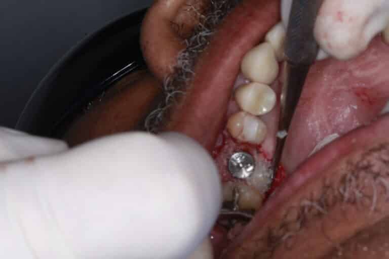 After Image: Implant crowns for Missing Teeth -