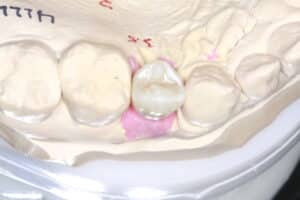 After Image: Implant crowns for Missing Teeth