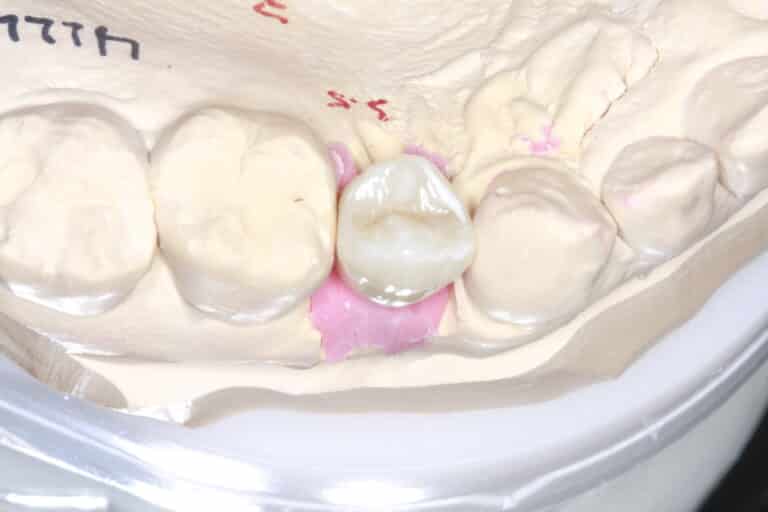 After Image: Implant crowns for Missing Teeth - front