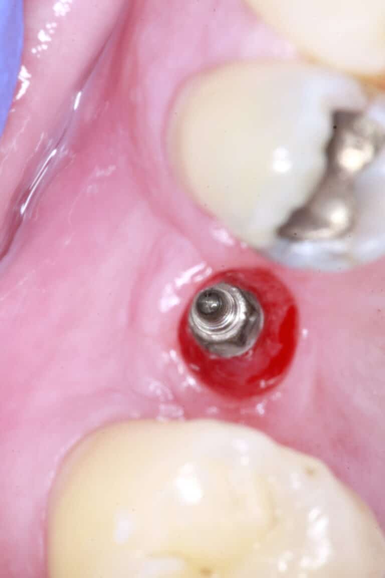 Before Image: Implant crowns for Missing Teeth -