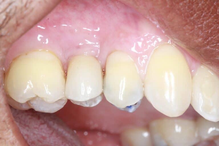 After Image: Implant crowns for Missing Teeth -