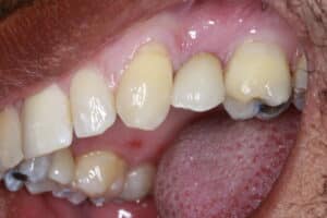 Before Image: Implant crowns for Missing Teeth