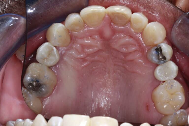 Before Image: Implant crowns for Missing Teeth -