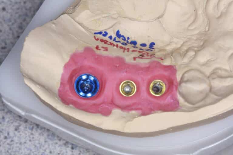 Before Image: Dental Implant Bridge for Missing Teeth - front