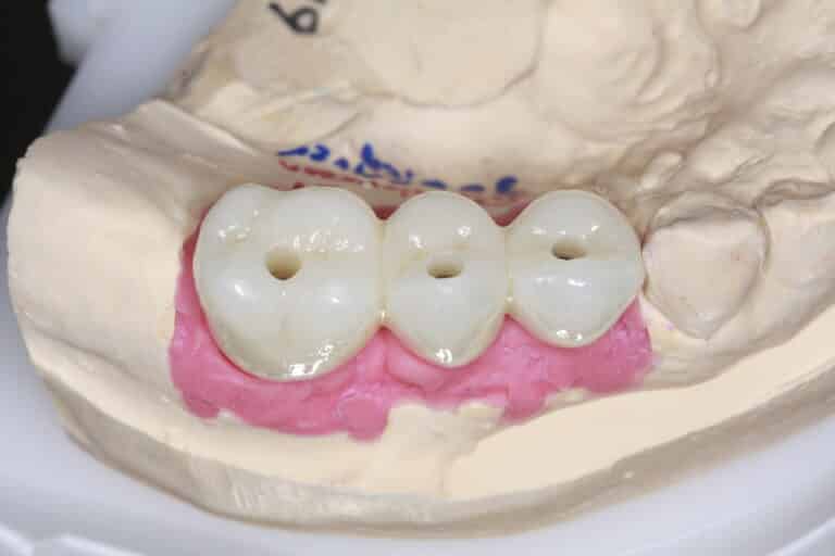 After Image: Dental Implant Bridge for Missing Teeth - front