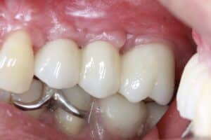 Before Image: Dental Implant Bridge for Missing Teeth