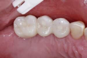 After Image: Dental Implant Bridge for Missing Teeth
