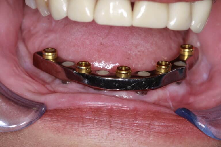 Before Image: Overdenture - front