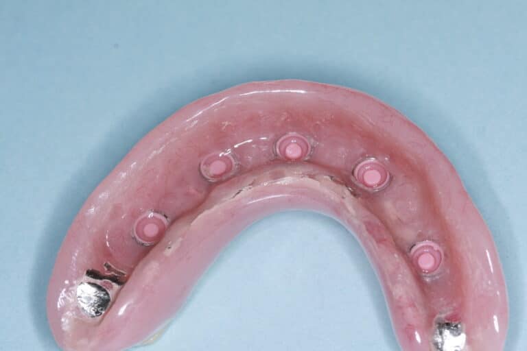After Image: Overdenture - front