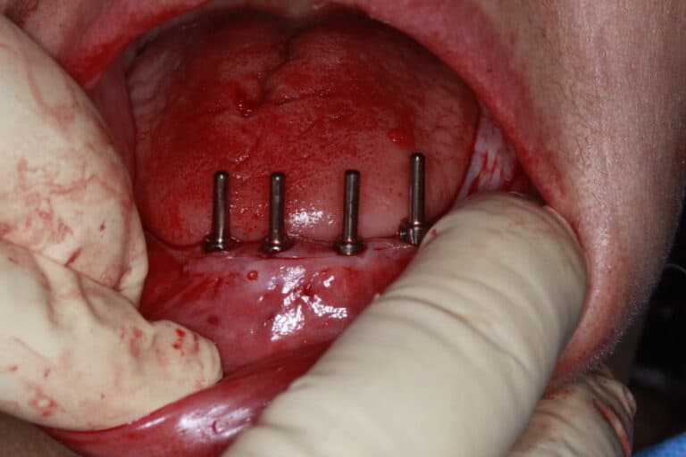 Before Image: Overdenture - front