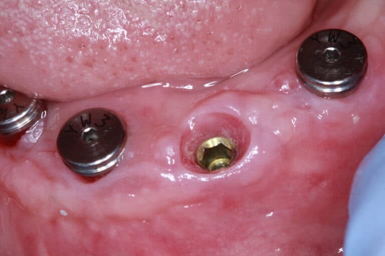 Before Image: Overdenture - front
