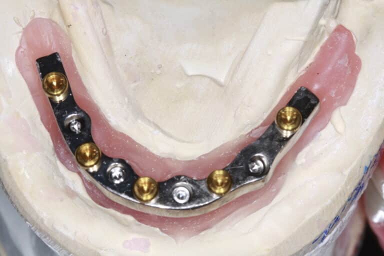 After Image: Overdenture - front