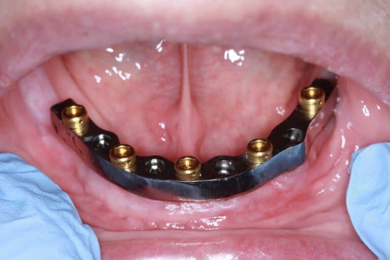 Before Image: Overdenture - front