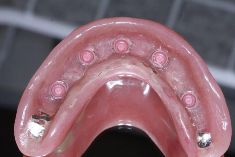 After Image: Overdenture - front
