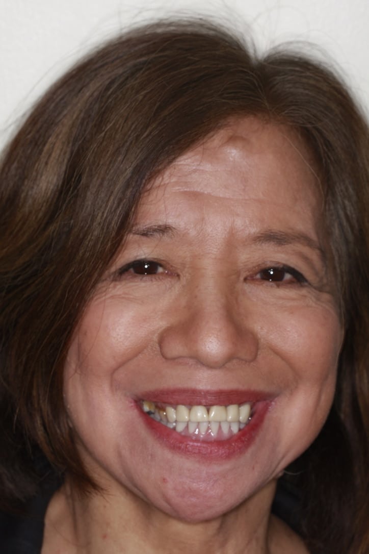 After Image: Overdenture - front