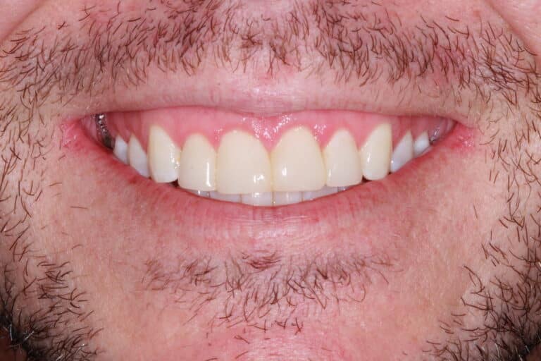 After Image: Advanced Composite Bonding - front