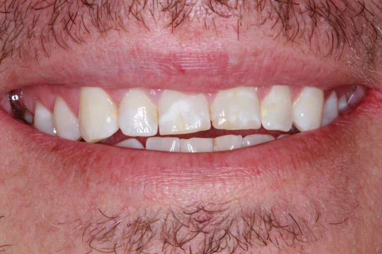 Before Image: Advanced Composite Bonding - front
