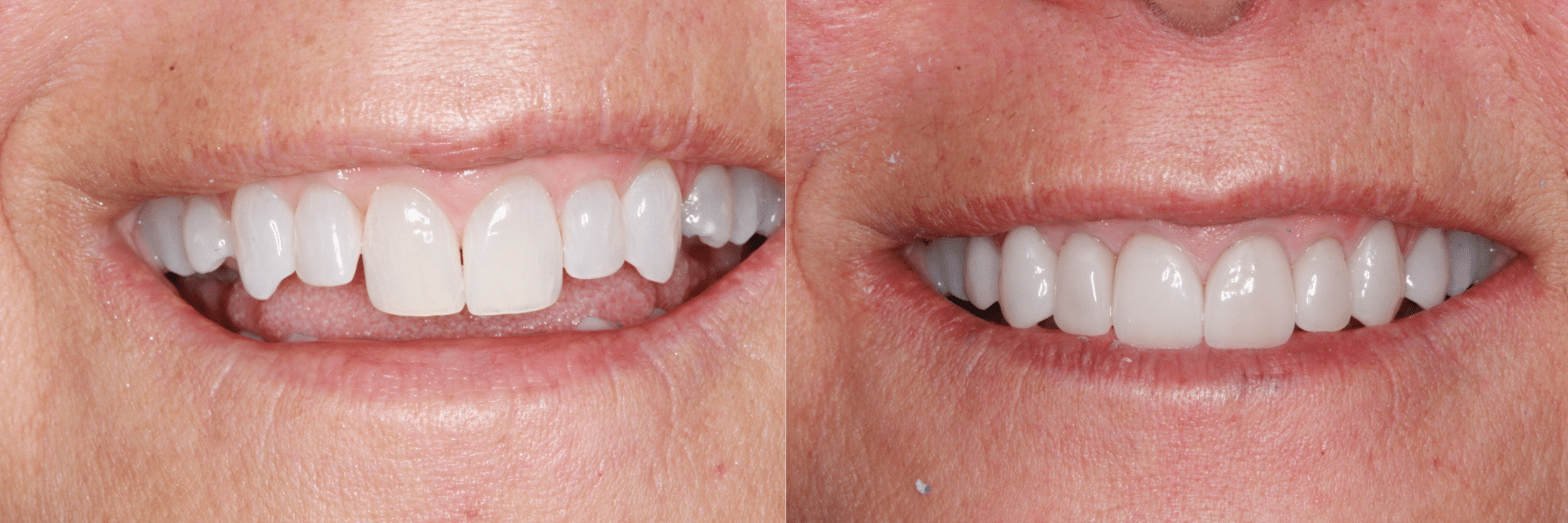 before and after