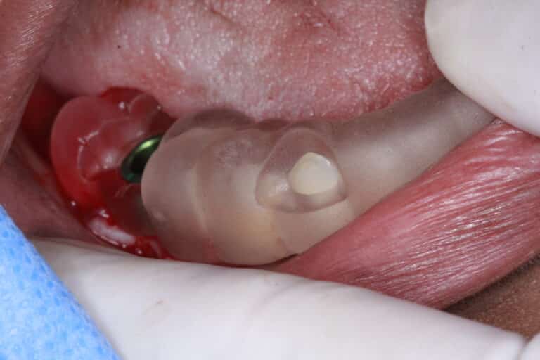 Before Image: Gold Crowns - front