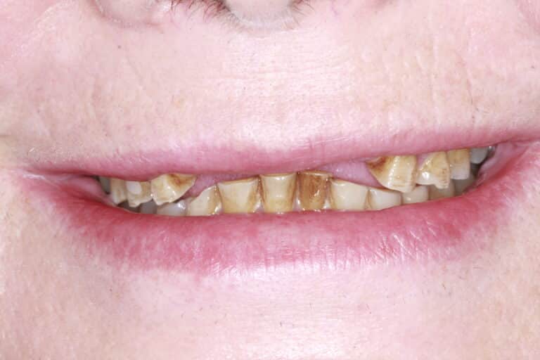 Before Image: Severe Wear - front