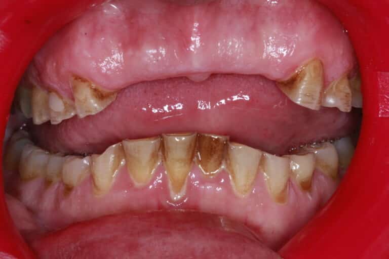 After Image: Severe Wear - front
