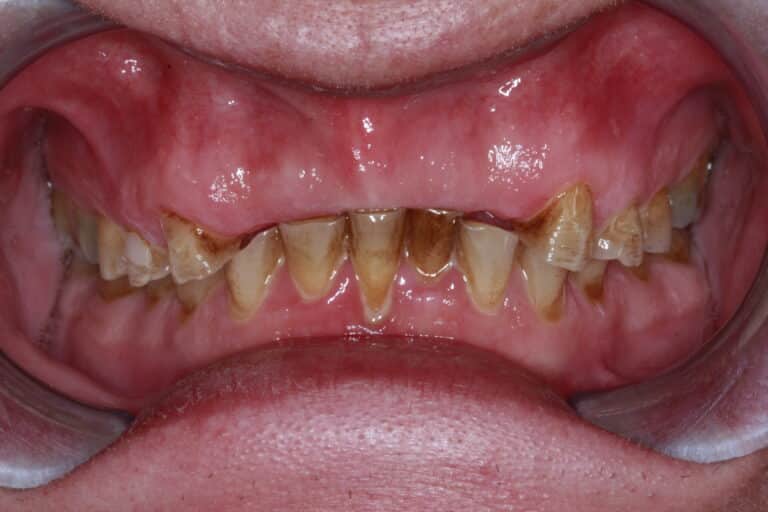 Before Image: Severe Wear - front