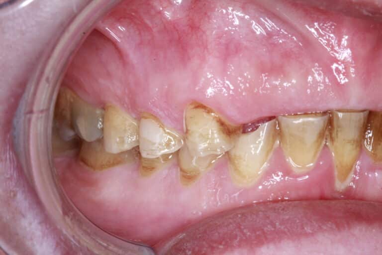 After Image: Severe Wear - front