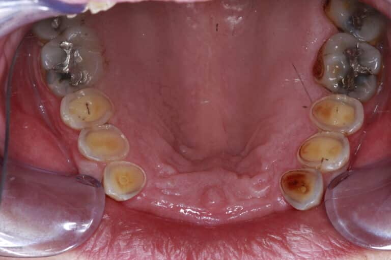 Before Image: Severe Wear - front